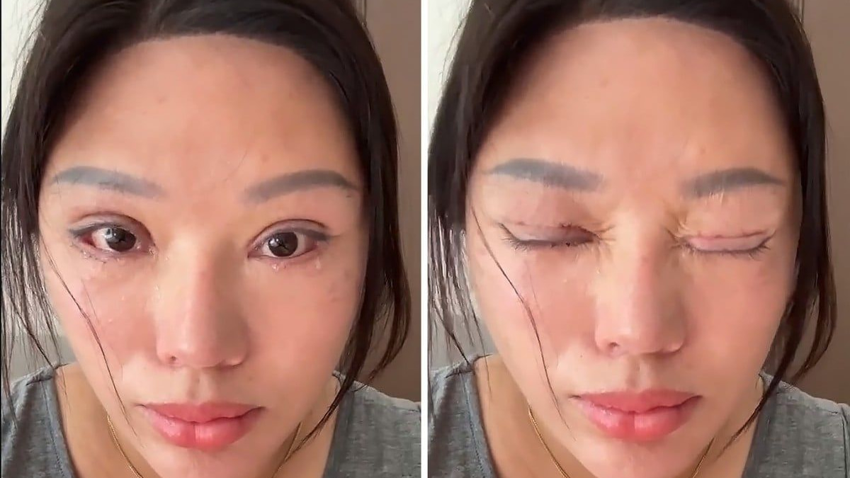 Chinese woman left unable to close eyes after botched cosmetic surgery, trapped in legal battle