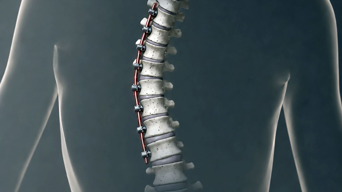 A New Approach to Scoliosis: Tension-Based Treatment Offers Alternative to Spinal Fusion