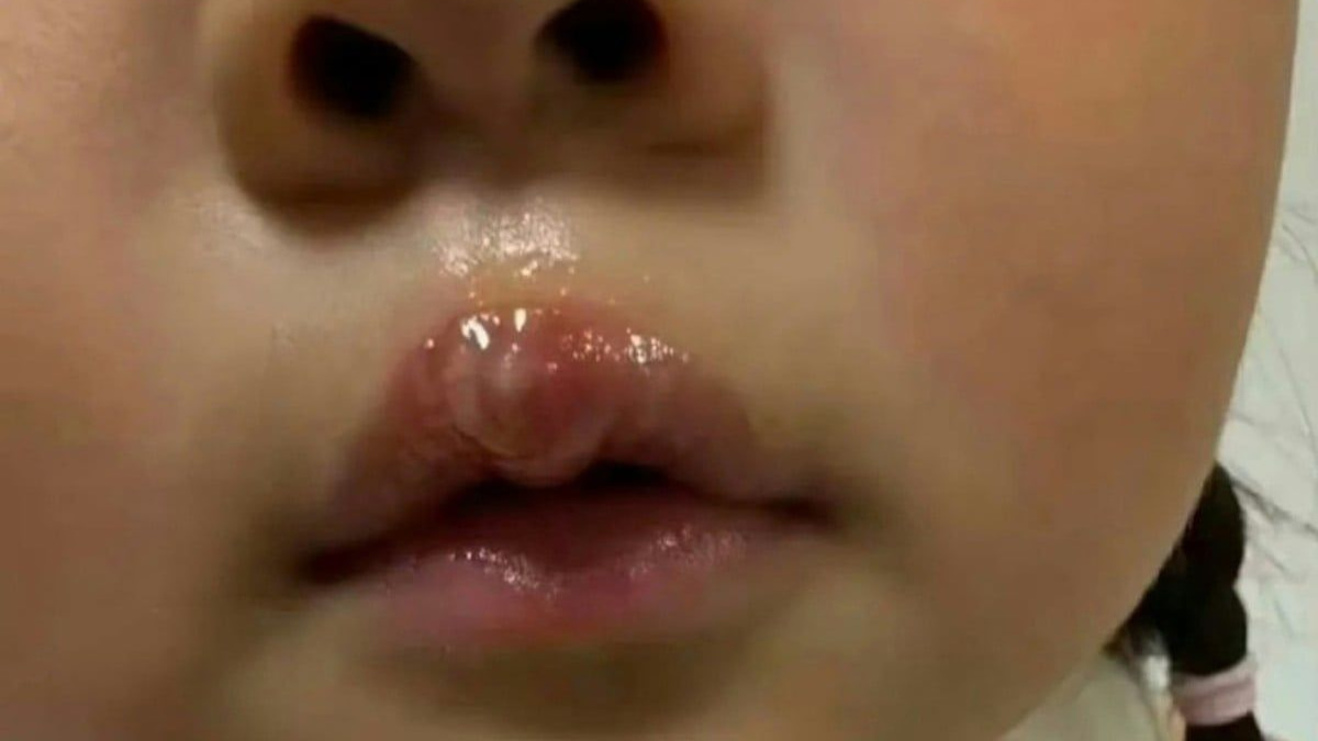 Chinese kindergarten teacher suspended after scalding girl's lip with hot glue gun